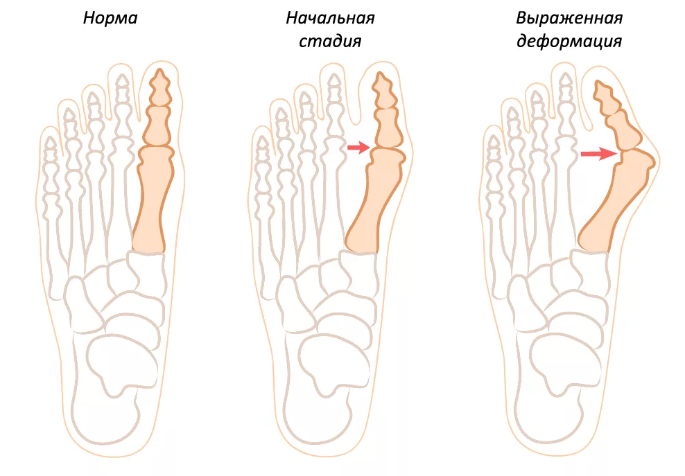 Как убрать вальгус. Вальгусная деформация первого пальца стопы. Вальгусная деформация косточки. Степени вальгусной деформации 1 пальца стопы. Вальгусная деформация 1 пальца.