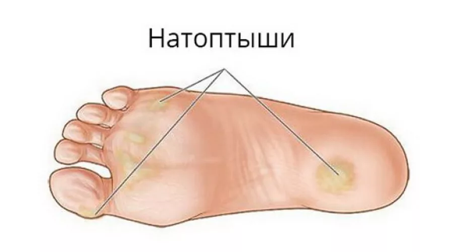 Под пальцами ног. Натоптыши на подушечке стопы. Натоптыш на большом пальце стопы.