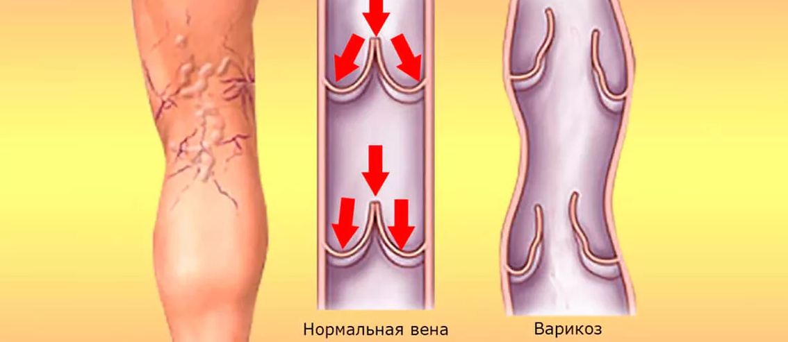 Клапан в венах ног. Варикозное расширение вен (ВРВ) нижних конечностей. Варикозно расширенная Вена. Варикозное расширение вен патанатомия. Венозная гиперемия варикоз.