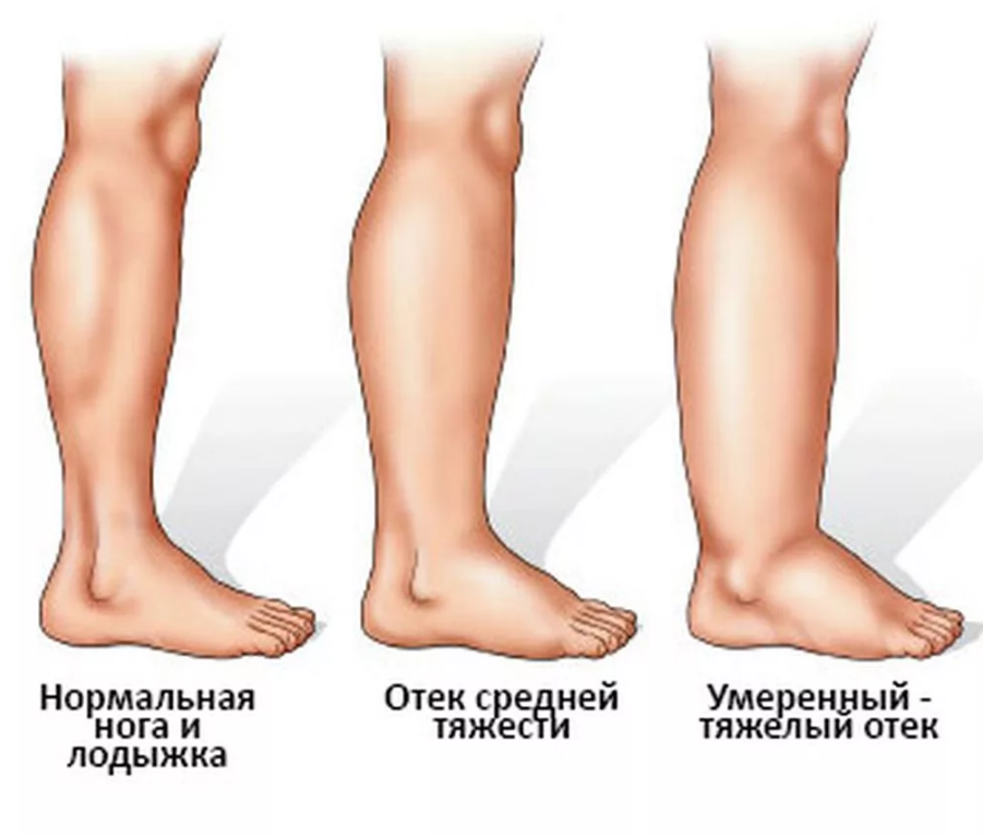 Отекают ноги и болят ступни