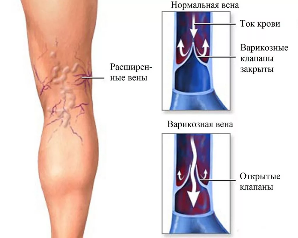 Венозный рисунок на ногах